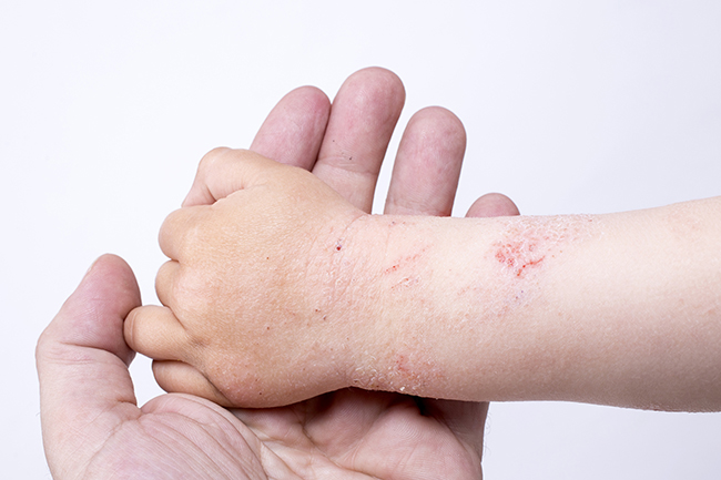 Bệnh viêm da cơ địa ở trẻ em: nguyên nhân và cách khắc phục